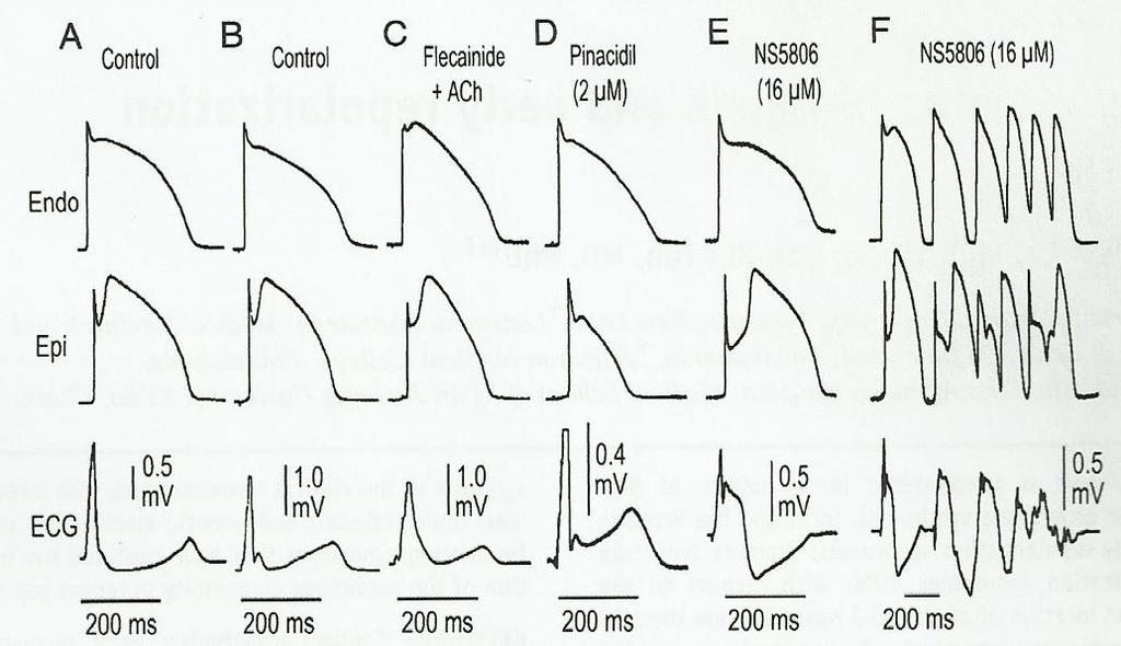 4 Figure 2 An illustration of how an ECG waveform can be generated by taking the difference between an endocardial and an epicardial potential. The tracings labelled ECG represent a transmural ECG.