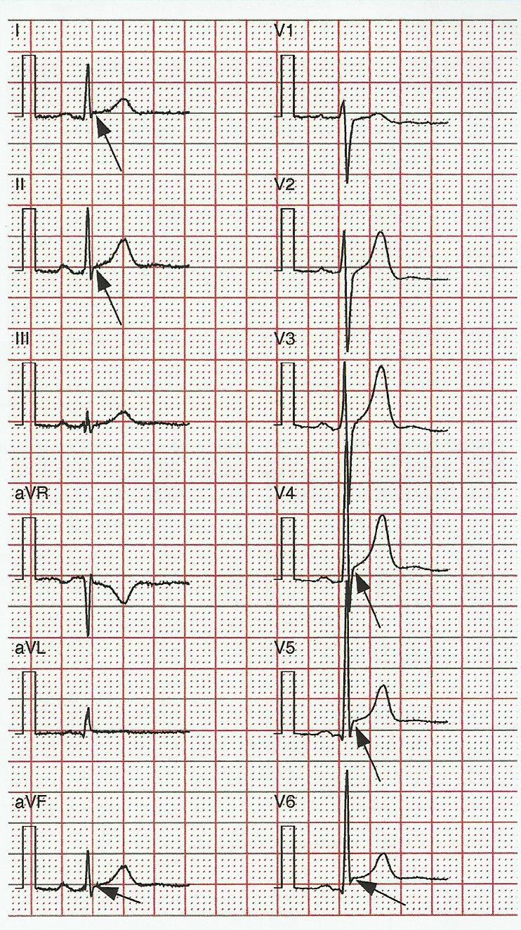 6 It is worth noting at this stage many cardiologists reported early repolarization on an ECG particularly if there was ST elevation in V4-V6 in what otherwise was a normal ECG (Figure 3).