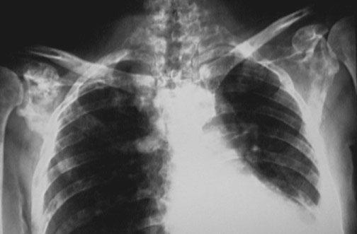 Plain x ray can be enough
