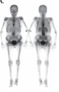 Bone scan of a female patient with breast cancers