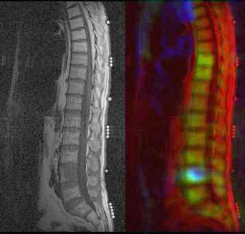 MRI and PET scan for bone metastases