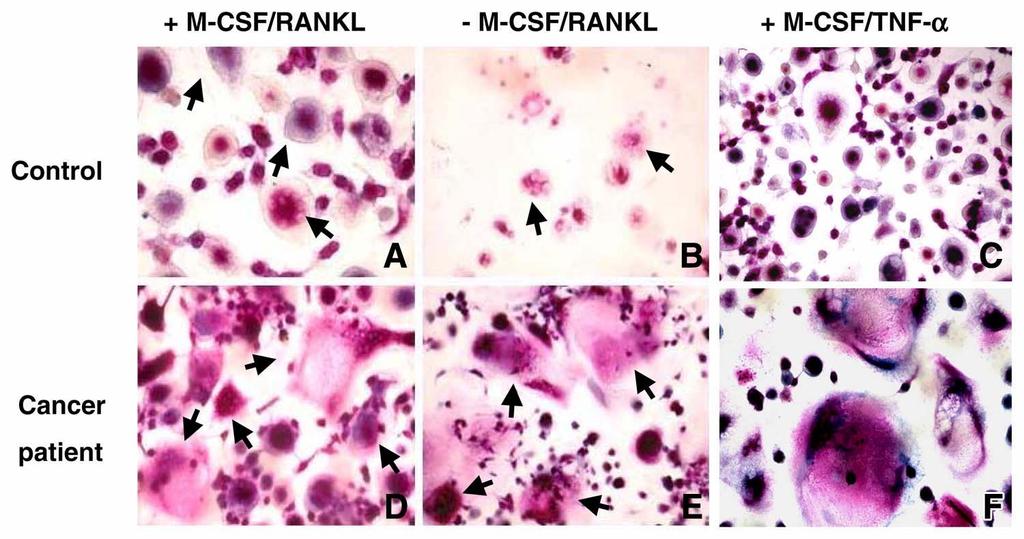 Spontaneous osteoclastogenesis in cancer patients :D,E,and F in comparison