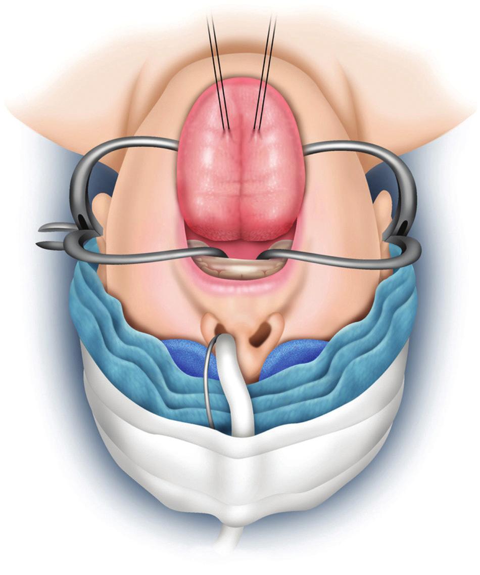 Friedman et al 857 Figure 2. The patient is intubated nasally, and a Jennings mouth gag is placed to allow for a transoral surgical approach.