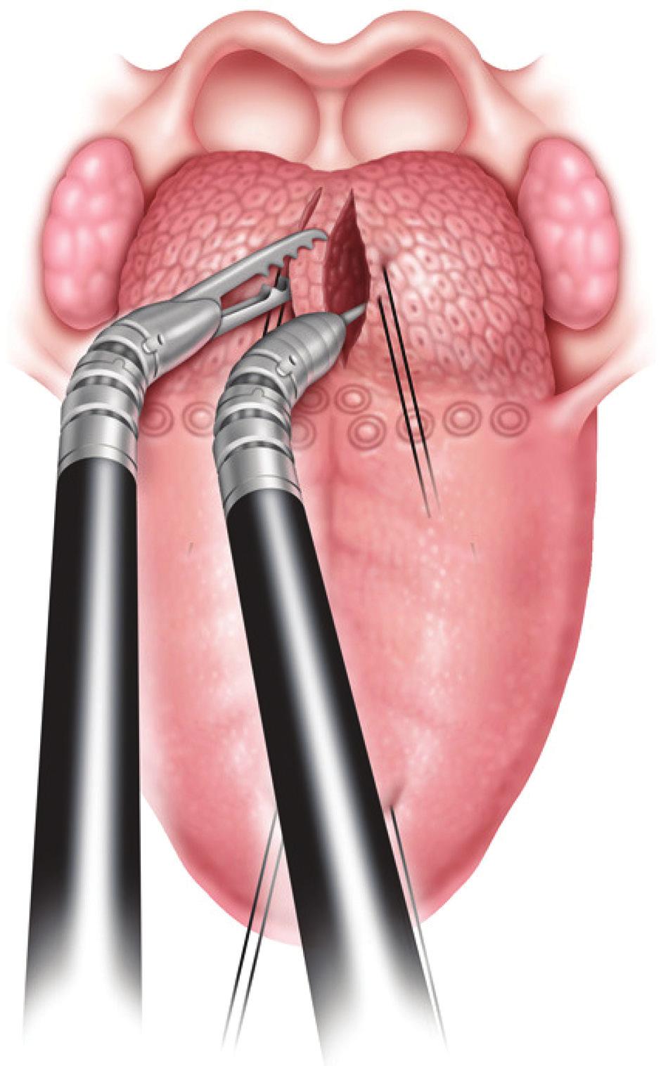 858 Otolaryngology Head and Neck Surgery 146(5) Figure 4.