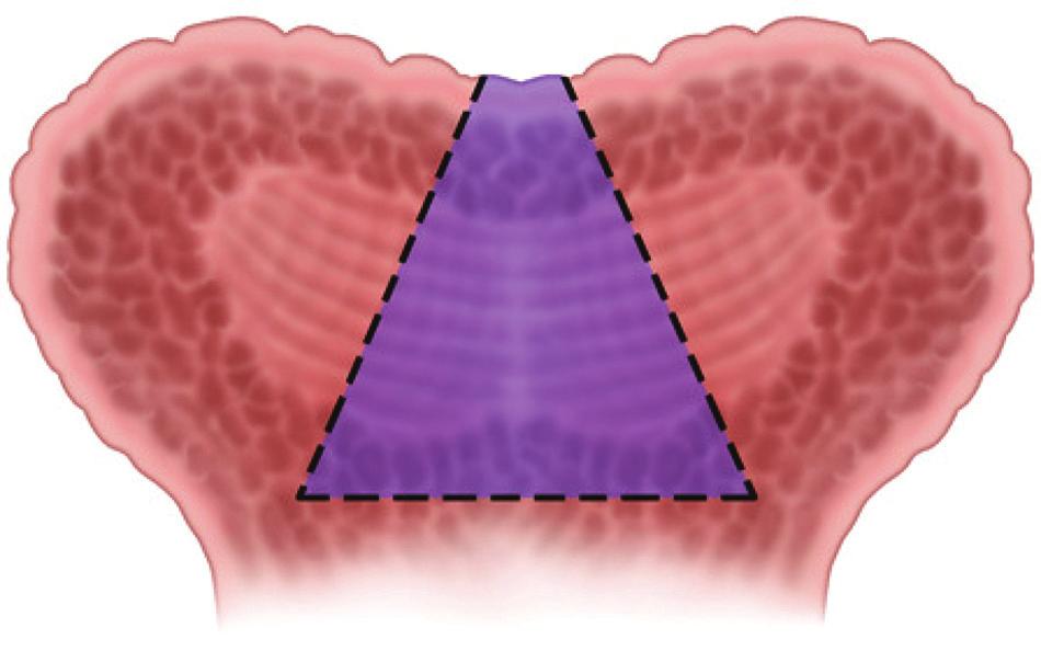 Two sutures at the lateral margins of the incision provide lateral traction. Figure 5. Mucosa and muscle are resected inferiorly in a triangular area. between categorical variables.