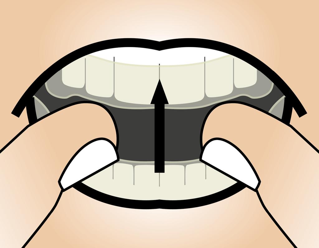The attachment point for the connector is on the upper jaw at the front and on the lower jaw at the back. 3.