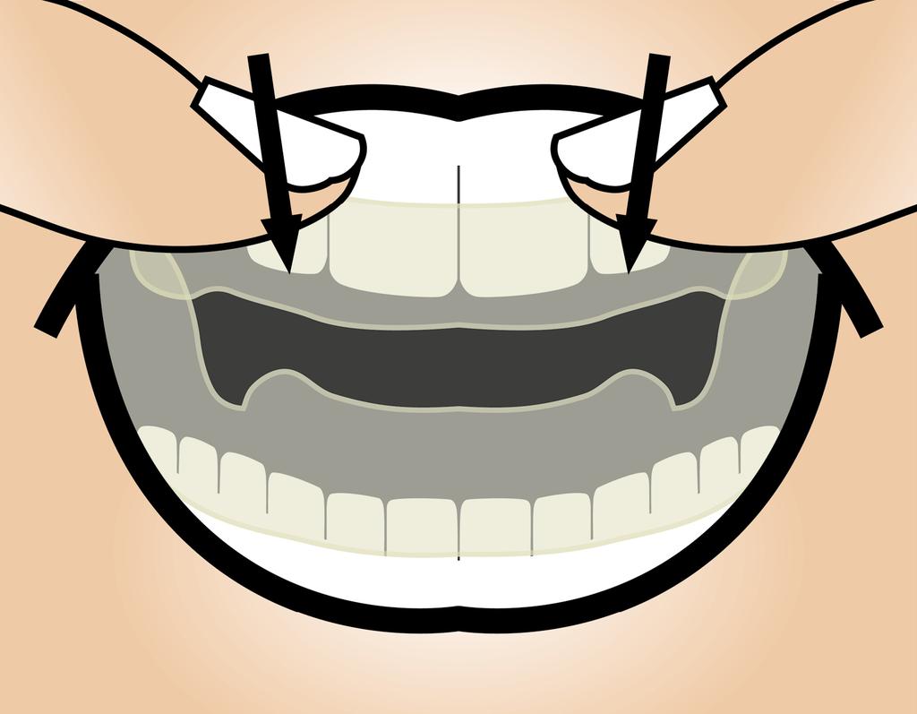 Ensure that it is possible to remove the appliance from the patient's teeth by exerting little force. 2.