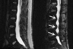 MRI Provide more detailed images of soft tissues (disc & Nerve roots) 1. Spinal stenosis 2. Disc bulge 3. Spinal tumors 4. Infections 5. Compressive lesions 6. Cauda equine.