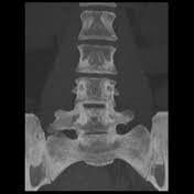 the sacral basis or iliac crest, producing a chronic, persistent lower back pain.