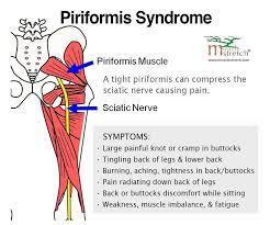 Piriformis syndrome Piriformis syndrome causes pain in the