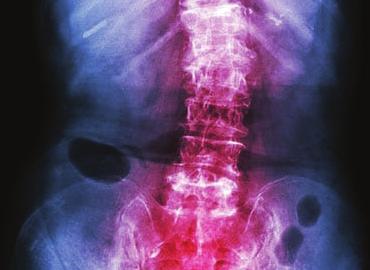 Scoliosis Decompression Decompression including North American Spine s unique IntelliSpine procedure may be used for cases in which the structural integrity of the vertebrae or spinal cord is not