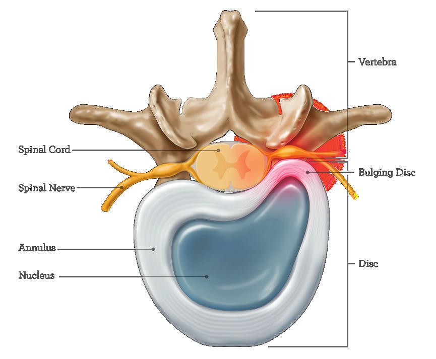 Bulging/Herniated Disc A bulging disc results when an intervertebral disc, which serves as a cushion between the spinal bones, loses its typical shape and compresses a nerve root in the spinal canal.