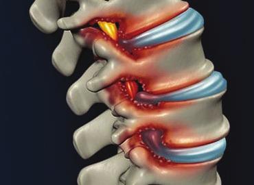 Radiculopathy Decompression Decompression including North American Spine s unique IntelliSpine procedure may be used for cases in which the structural integrity of the vertebrae or spinal cord is not