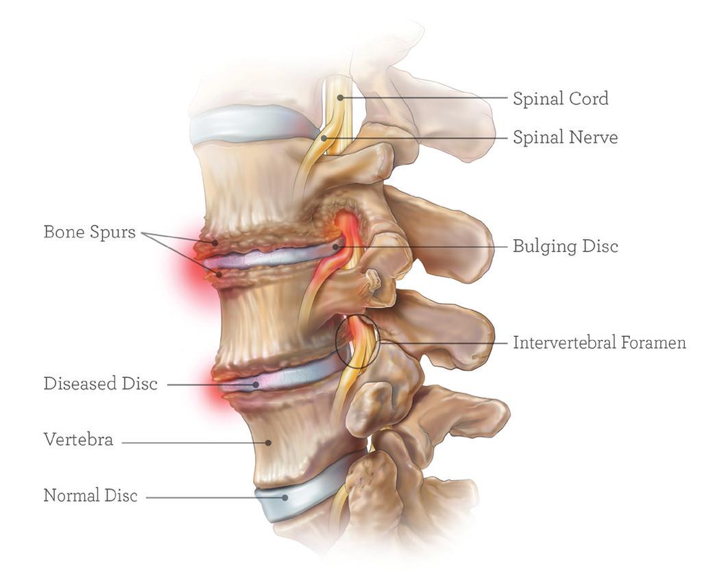 Degenerative Disc Disease Degenerative disc disease is a condition that can develop in all sections of the spine due to wear and tear in the cushioning discs that sit between your spinal bones and