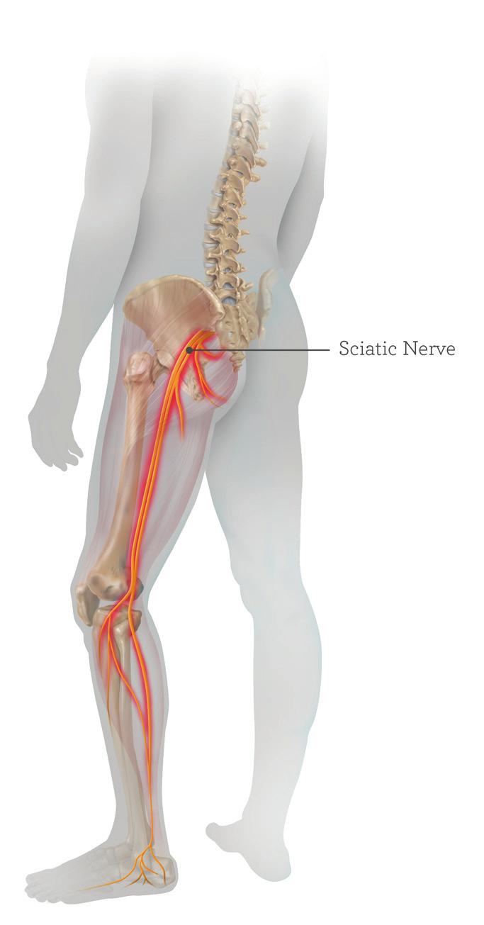 Sciatica Sciatica refers to pain and possibly numbness, tingling, and weakness that originates in the lower back and travels through the buttock and down the large sciatic nerve located in the back