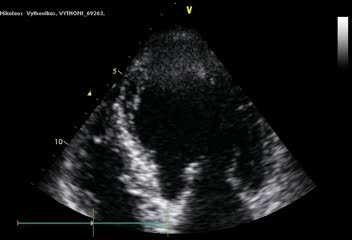 Functional MR 66 year-old male Dilated