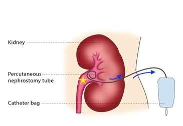 Figure 1. A schematic view of the impact of a percutaneous nephrostomy.