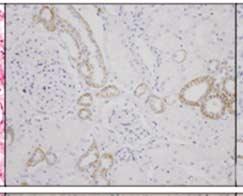 Renal Oncocytoma 307
