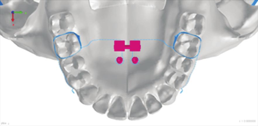 Eom et al Maxillary protraction using palatal plates Type A Facemask Expansion Type A O X Type B O X Type C O X Type D X X Type E O O Type F X O Type D Type B Type E Type E = Type C + RME Type F =