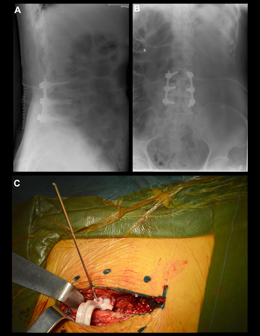 Chen H. et al.: A B C Figure 3. (A) The post-operative lateral x-ray films; (B) The post-operative anterior-posterior x-ray films.
