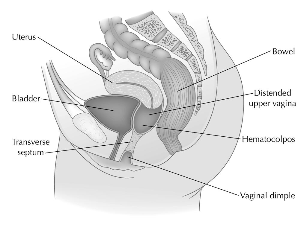 448 Adolescent Health Figure 2. Noncommunicating vertical fusion defect of the transverse vaginal septum.