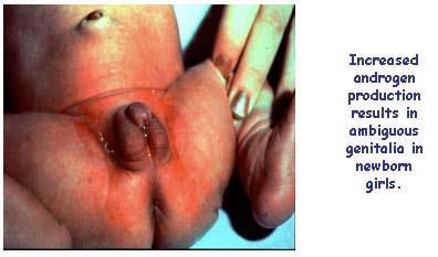 EXAMINATION OF THE NEWBORN FOR AMBIGUOUS GENITALIA Disorders of sexual development (DSD) ambiguous genitalia: 1 in