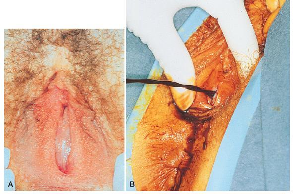IMPERFORATE HYMEN Comprehensive Gynecology 7 th