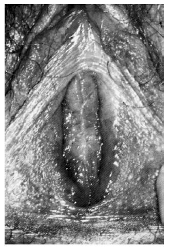 VAGINAL AGENESIS also known as Mullerian agenesis or Mullerian aplasia associated with the Mayer Rokitansky Kuster Hauser (MRKH) syndrome.