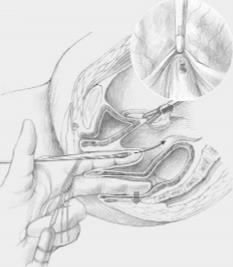 VAGINAL AGENESIS TREATMENT Vecchietti procedure: laparoscopic procedure where sutures are placed in the peritoneal