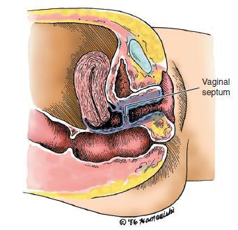 TRANSVERSE VAGINAL SEPTUM The Mullerian ducts join the sinovaginal bulb at a point known as the Mullerian tubercle.