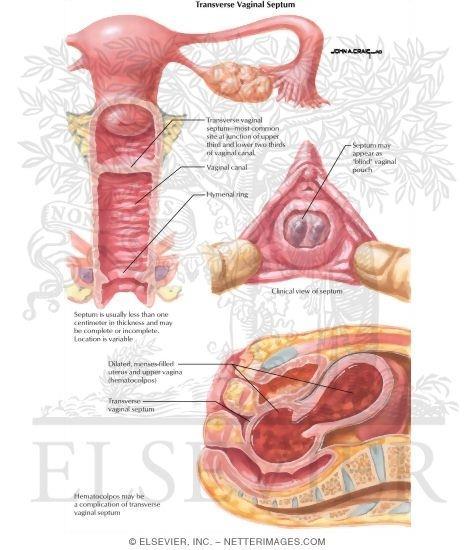 TRANSVERSE VAGINAL SEPTUM Hematocolpos and hematometrium may occur in a fashion similar to that seen in the imperforate hymen, except that