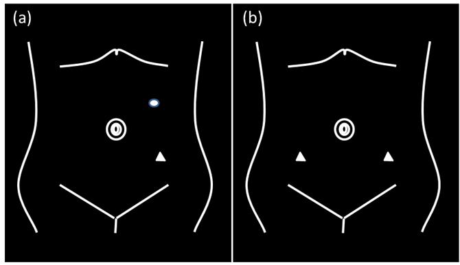 Yutaro Tanaka et al Figure 1. (a) Port placement for left-side nephroureterectomy.