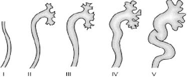 Figure 4. Grades of vesicoureteric reflux. Gr. I reflux into non dilated ureter; Gr. II reflux into ureter and pelvis; Gr. III and Gr. IV reflux occurs into dilated ureter; Gr.