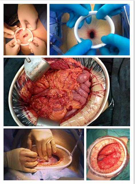 Anastomosis The supraumbilical port was enlarged and the freed right colon and terminal ileum were mobilized through the wound with wound protector in place.