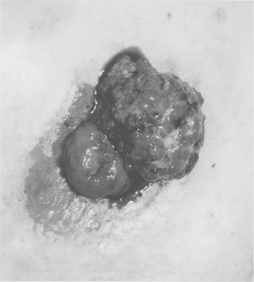 Gut, 1988, 29, 1607-1612 Primary mucinous adenocarcinoma developing in an ileostomy stoma P J SMART, S SASTRY, AND S WELLS From the Departments of Histopathology and Surgery, Bolton General Hospital,