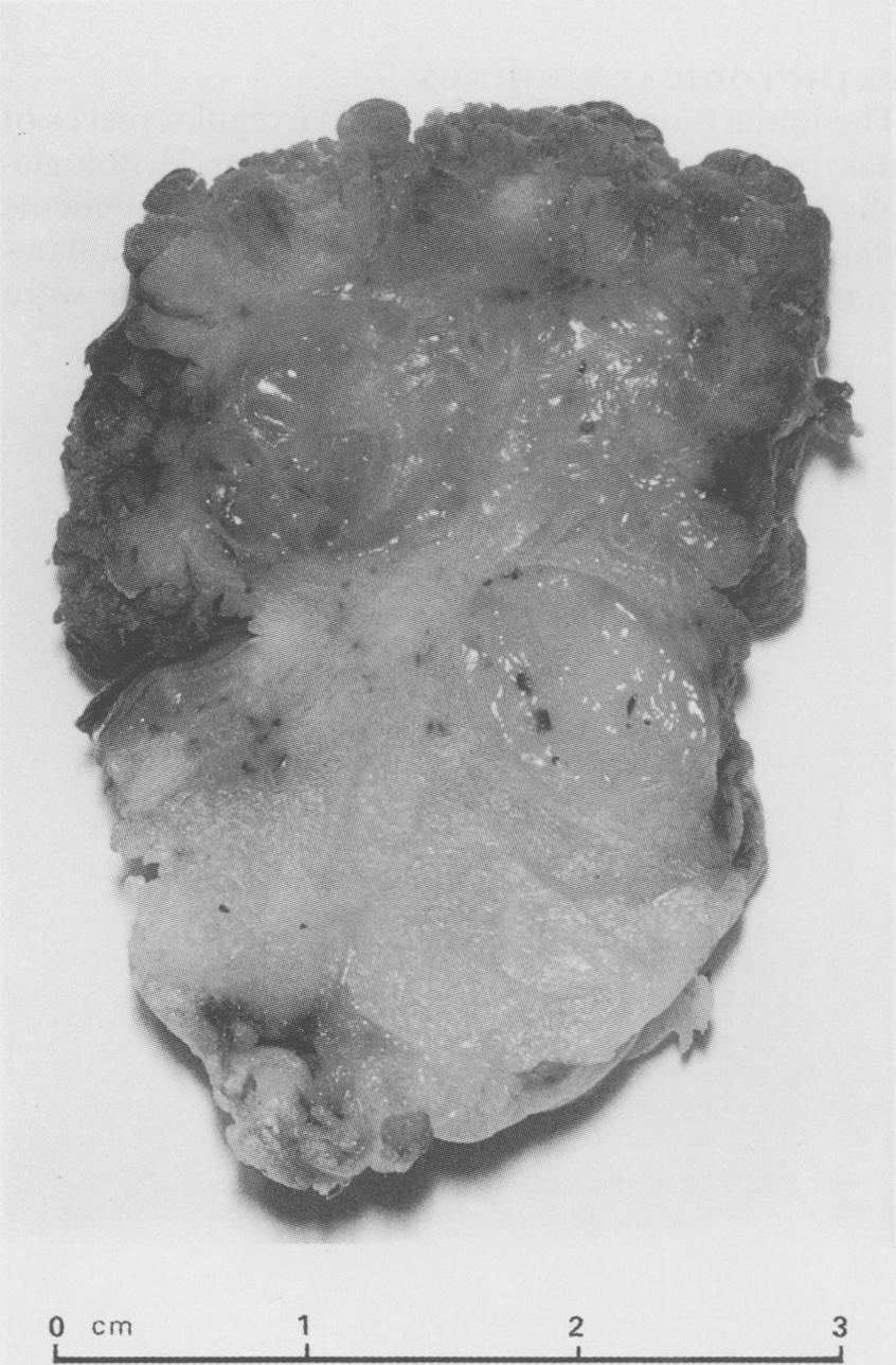 1608 interpreted as representing origin from a tubulovillous adenoma. Although invasive neoplasia could not be seen there was a possibility of invasive neoplasia in the remaining tumour.