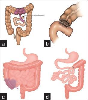 small bowel disease <20% with ileal disease develop