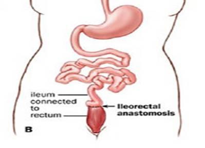 Total Colectomy (rectal sparing) Total Colectomy (rectal sparing) 1) Attach small bowel to rectum 1) Attach