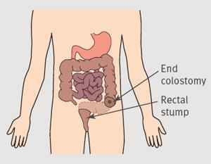 s procedure: Partial colon resection and end colostomy Crohns: Will I need another surgery?