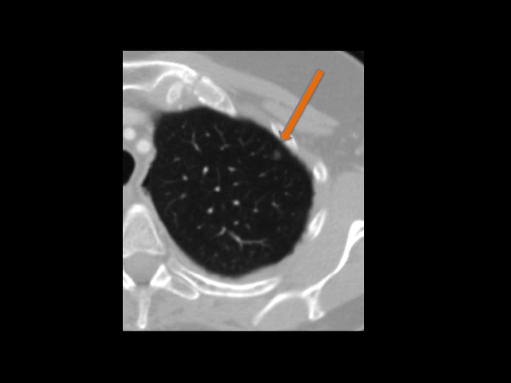 Fig. 6: Axial chest CT scan with lung window.