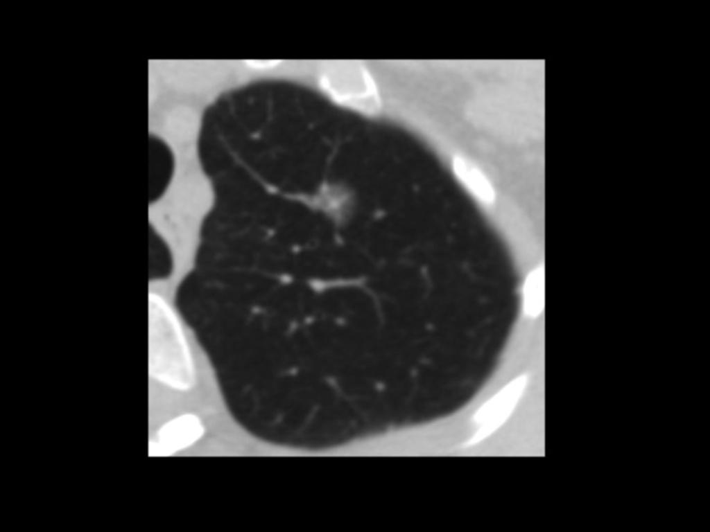 Fig. 8: Axial chest CT scan with lung window. Solitary part-solid GGN in the superior left lobe with a solid component<5mm.