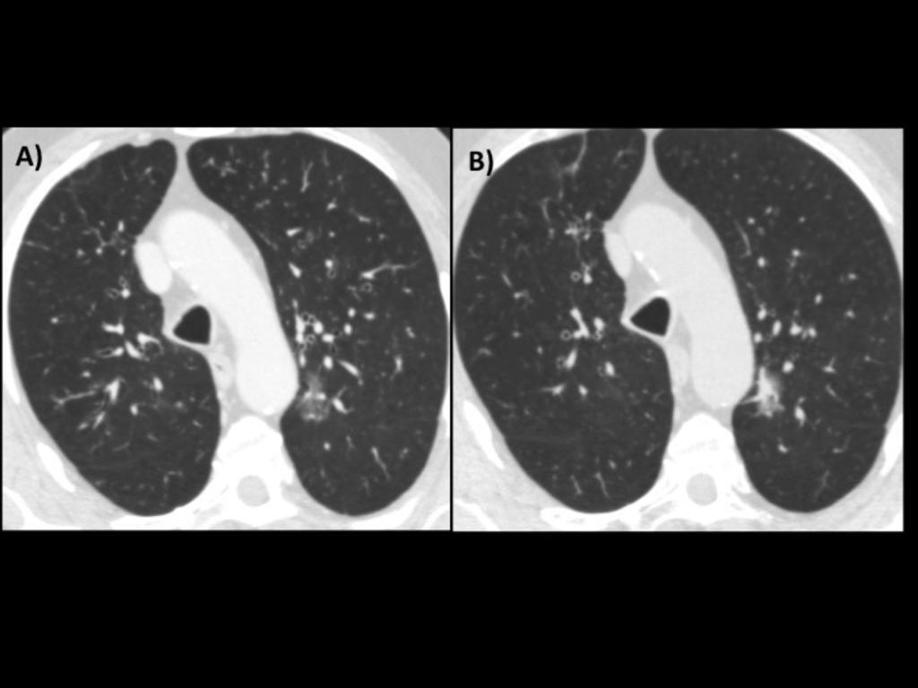 Fig. 9: A)Part solid groud glass nodule on the left superior lobe and B) follow up CT 6 months later.