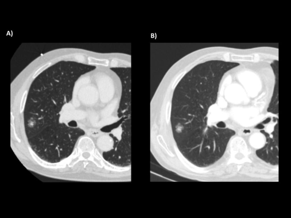 Fig. 11: A)Part solid groud glass nodule on the left superior lobe with a solid component of 7mm. B) follow up CT 3 months later.