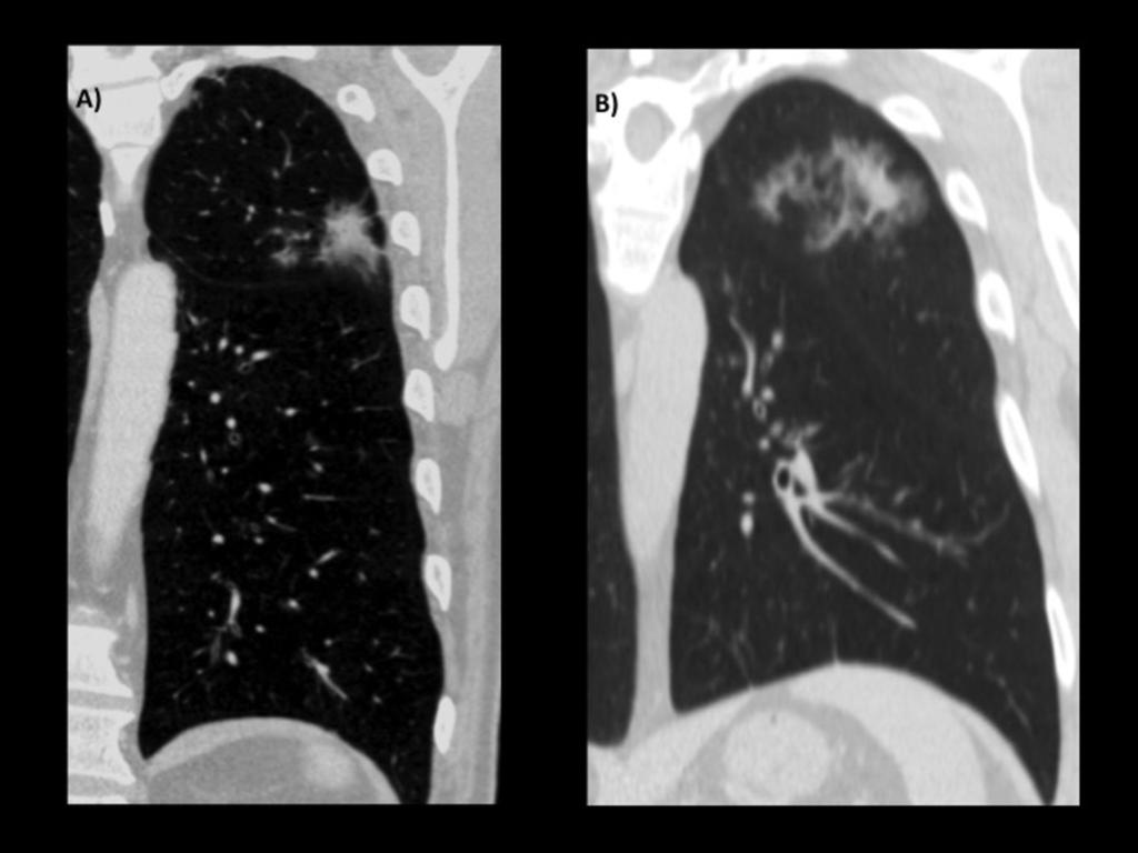 Fig. 12: A)Part solid ground glass nodule and B) follow-up CT 3 months later. The nodule is now a lesion with bubblelike lucencies.