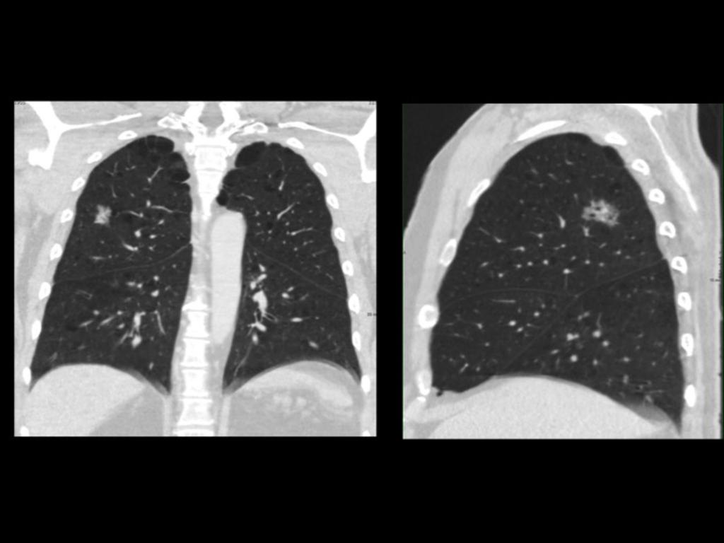 Fig. 13: Chest CT scan with lung window. Part solid ground glass nodule with bubblelike lucencies in the right superior lobe.