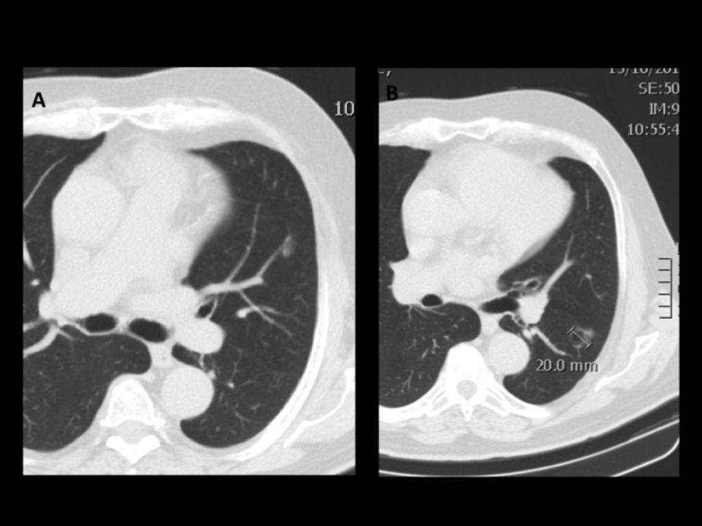 Fig. 14: Patient with multiple pure subsolid nodules >5 mm in the left upper lobe and in the left inferior lobe with cavitation.