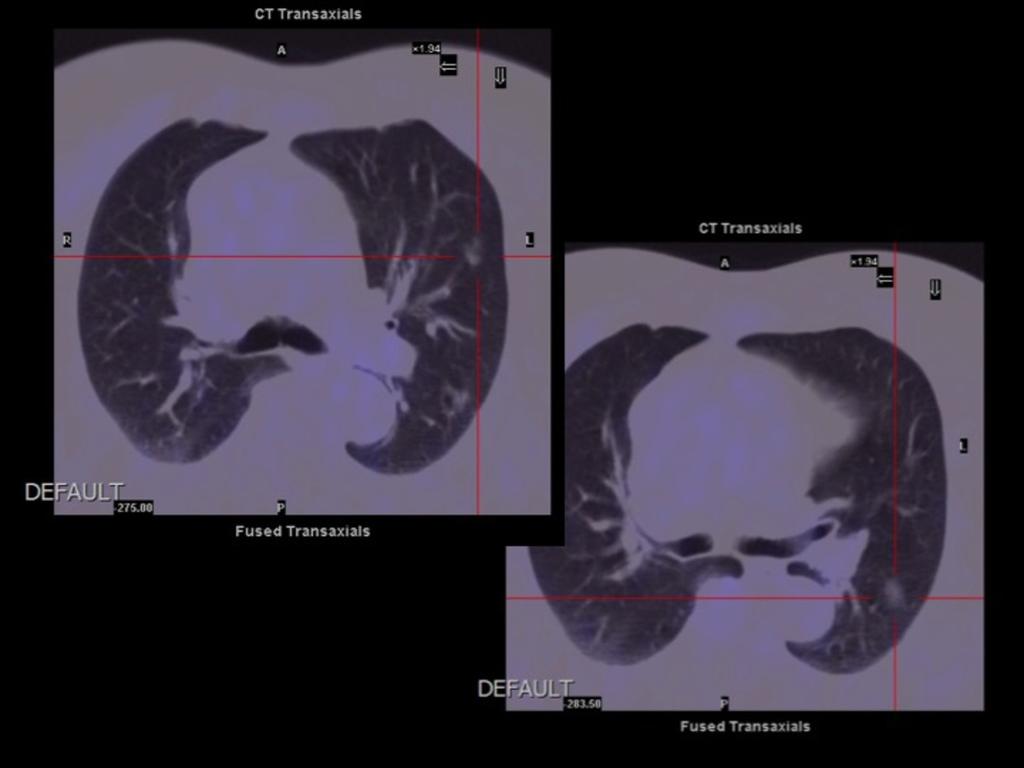 Fig. 15: PET CT images of the same patient as in figure 13)