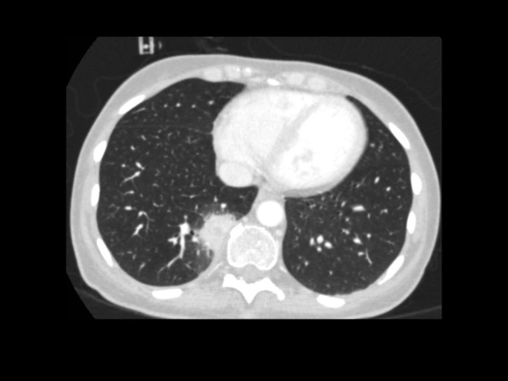 Fig. 3: Figure 3: axial contrast enhanced CT shows a subsoild lesion (it incorporates both solid and ground glass elements) in the right lower lobe that was due to an infection by Aspergillus.