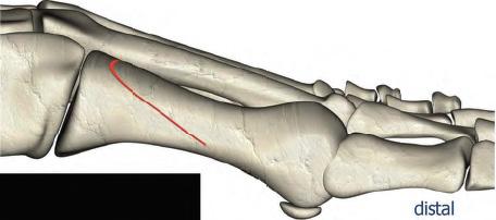 Figure 2 Ludloff Osteotomy cut proximal distal Figure 3