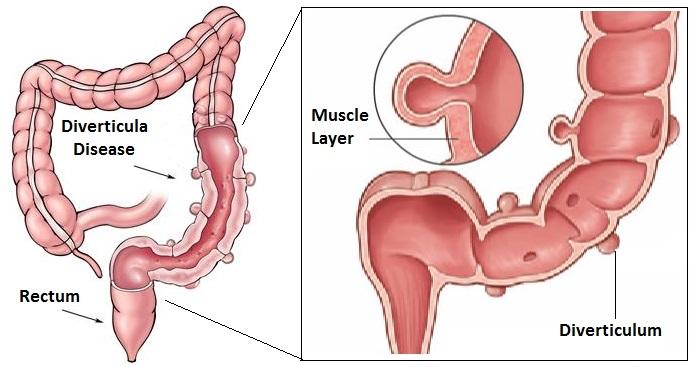 WHAT IS DIVERTICULAR DISEASE? A diverticulum is a pouch that forms with a narrow neck on the inner lining of the colon/ large bowel.
